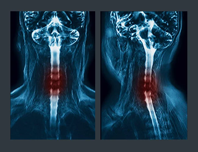 Cervical Facet Syndrome