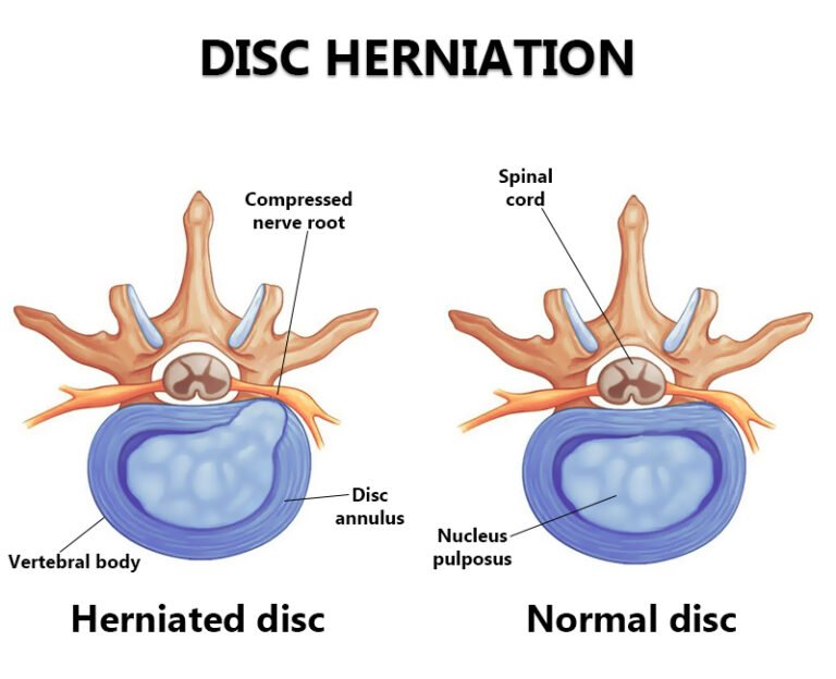 Cervical Herniated Disc