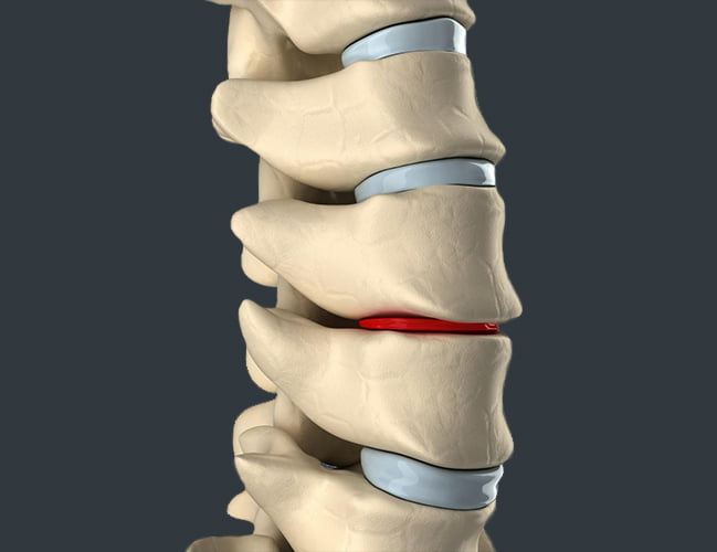 Lumbar Bulging Disc