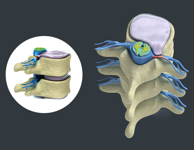 Lumbar Disc Herniation