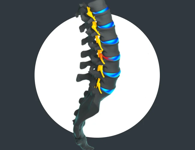 Lumbar Radiculopathy