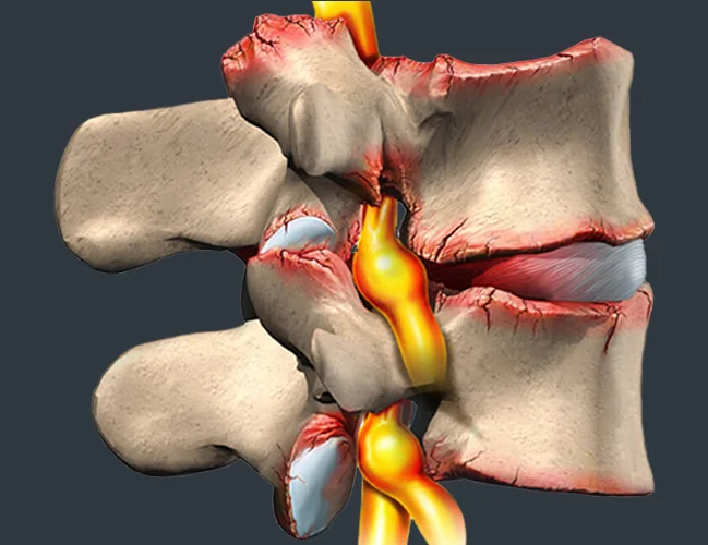 Lumbar Spine Degenerative Disc Disease