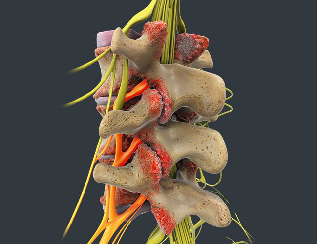 Lumbar Stenosis