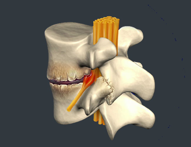 Spondylosis