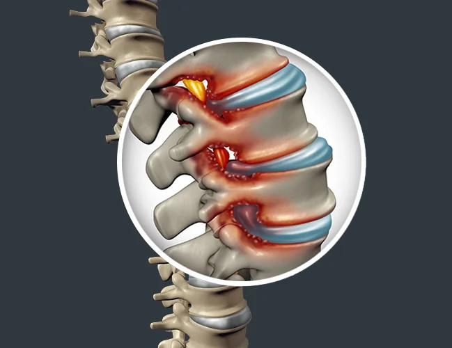 Thoracic Degenerative Disc Disease