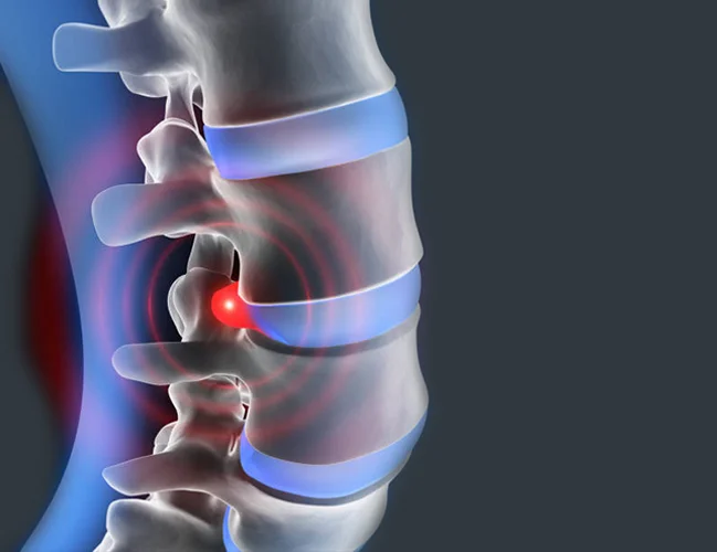 Thoracic Disc Herniation
