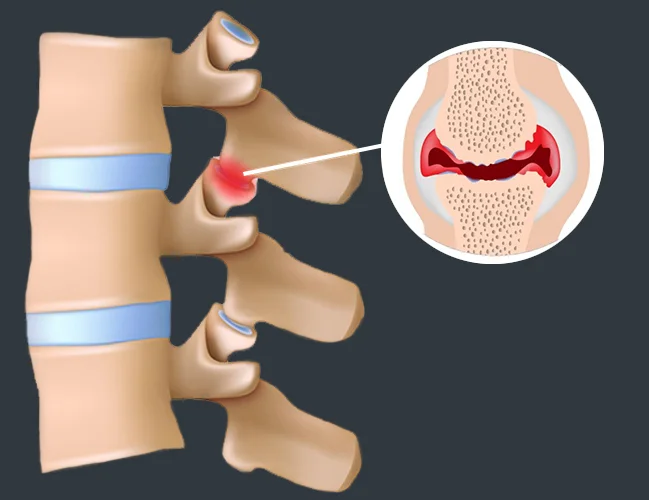 Thoracic Facet Syndrome