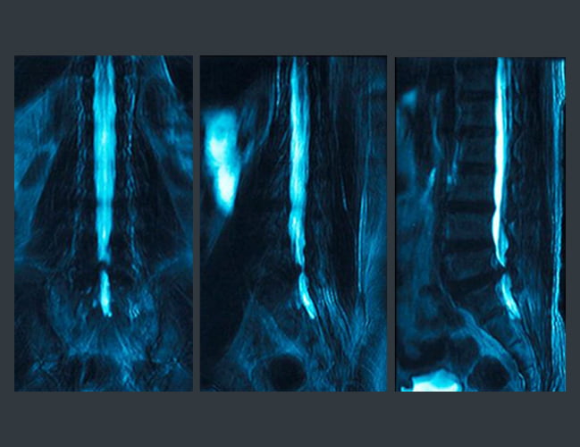 Thoracic Radiculopathy