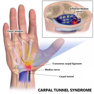 Carpal Tunnel Pain Treatment NJ & NYC | Hand Pain Relief Doctor