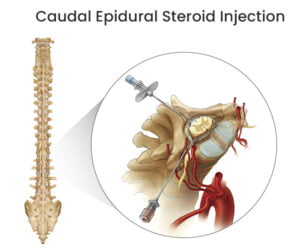 Caudal Epidural Steroid Injection In Nj Nyc The Spine Rehab Group