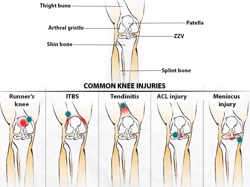 Knee Injuries NJ NYC