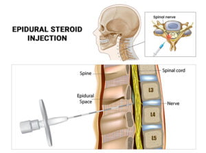 How Effective Are Epidural Steroid Injections For Herniated Disc