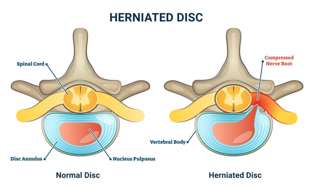 Can a Hernia Cause Back Pain? | The Spine & Rehab Group