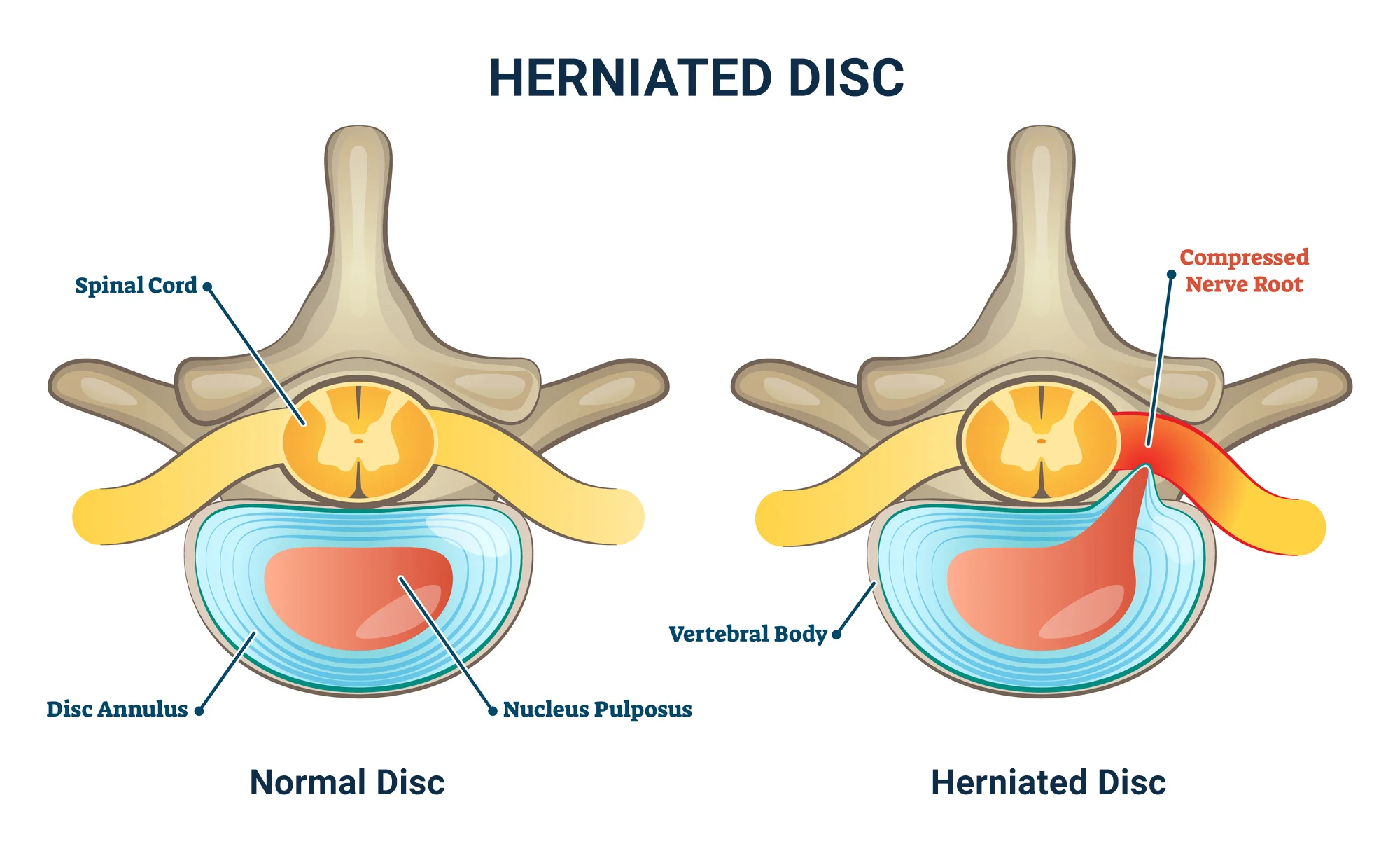 Can a Hernia Cause Back Pain? | The Spine &amp; Rehab Group