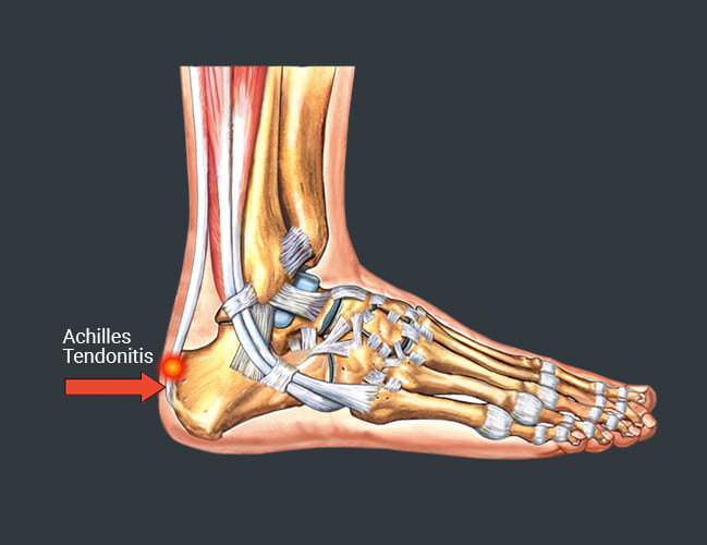 Achilles Tendonitis