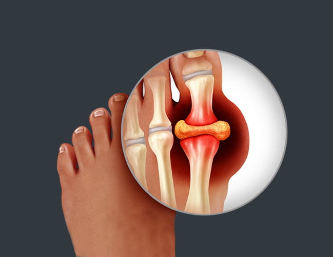 Arthritis of the Foot or Ankle