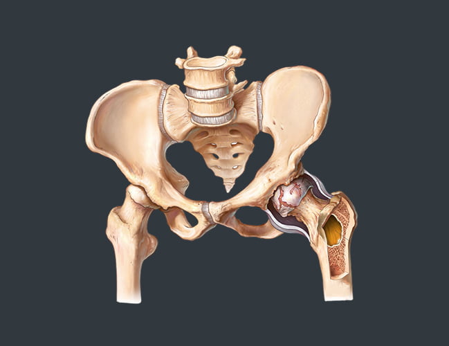 Arthritis of the Hip