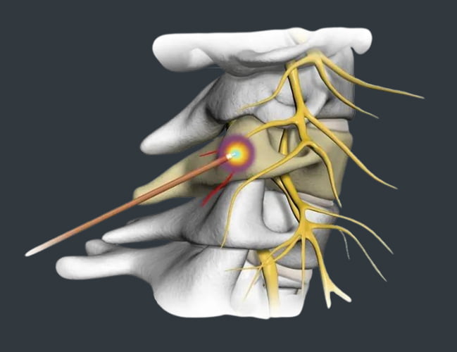 Cervical Radiculopathy