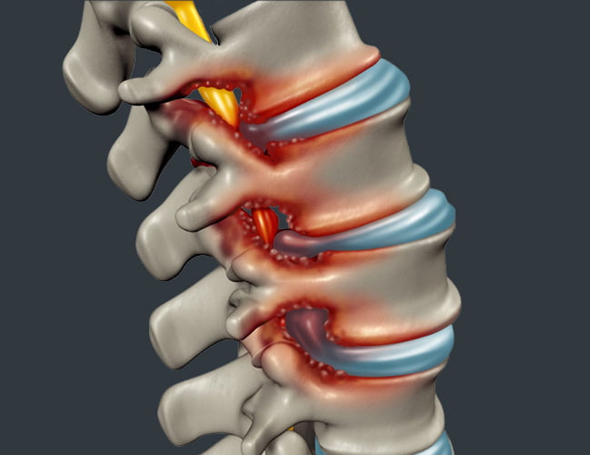 Degenerative Disc Disease