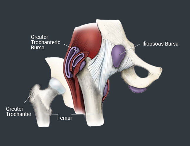 Hip Bursitis