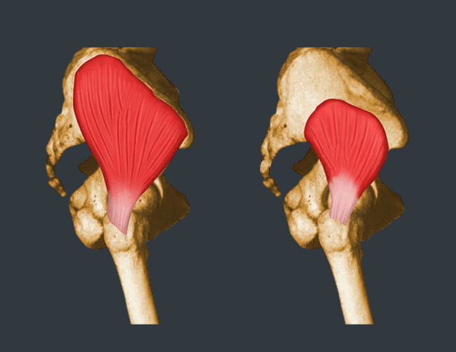 Hip Tendonitis