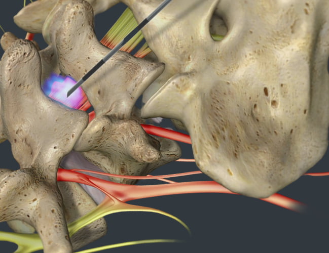 Lumbar Epidural Steroid Injections