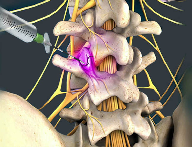 Medial Branch Blocks