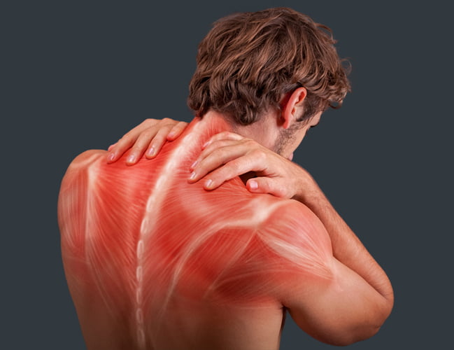 Myofascial Pain Syndrome