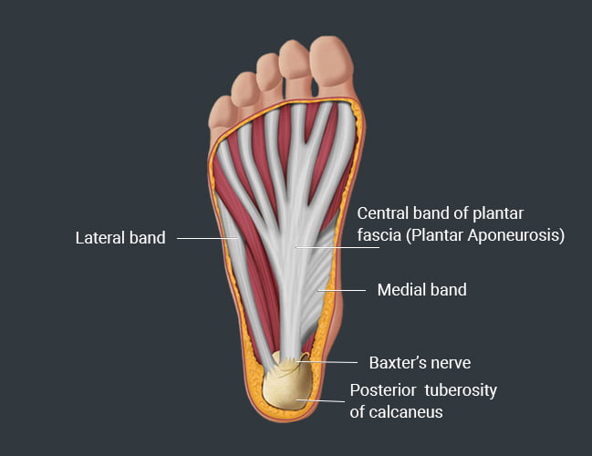 Plantar Fasciitis