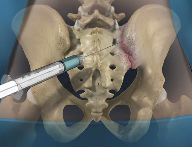 Sacroilliac Joint Injections