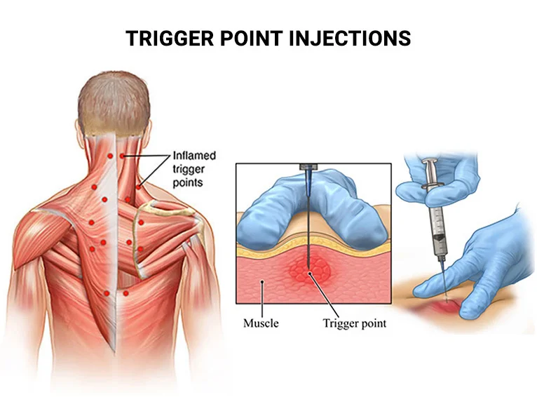 At DrStemCellsThailand's Anti-Aging and Regenerative Medicine Center, we utilize trigger point injections of cellular therapy and stem cells as a targeted approach to treat various musculoskeletal conditions, including myofascial pain syndromes and chronic muscle tension. This technique allows for localized delivery of therapeutic agents directly into trigger points, promoting healing and reducing pain.