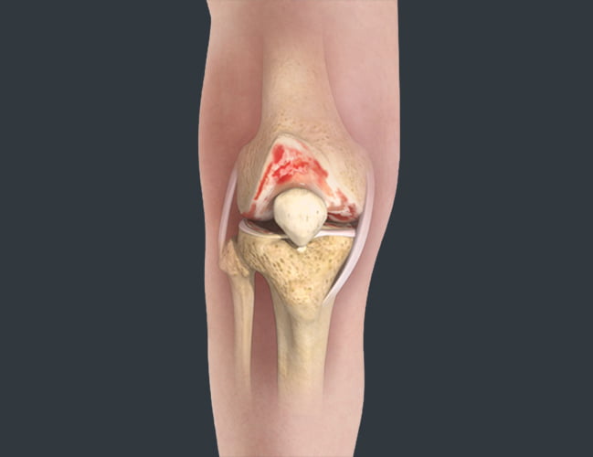 Arthritis of the Knee