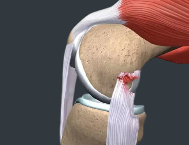 Anatomy of Knee Ligament Injury