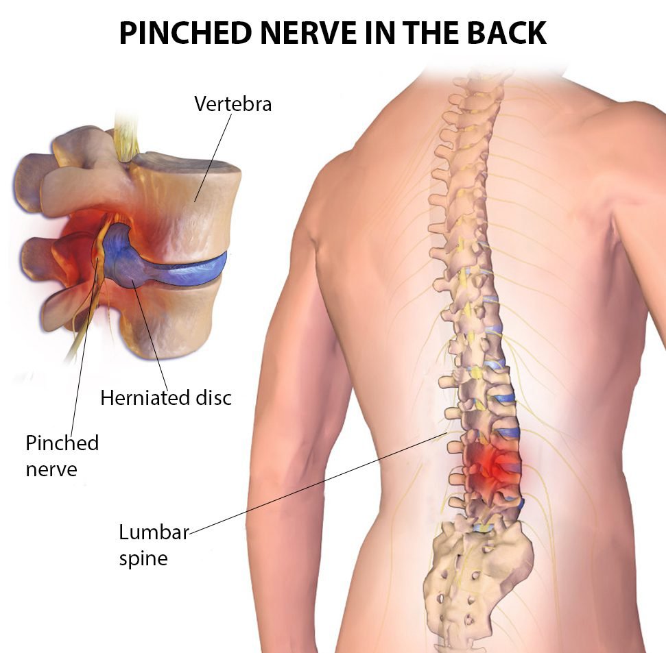 Pinched Nerve Doctor NJ | Pinched Nerve Specialists in New Jersey