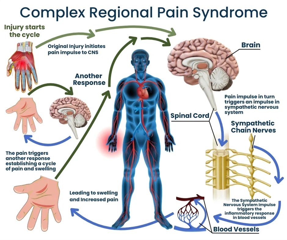 CRPS Specialist NJ | Complex Regional Pain Syndrome Doctor in New 