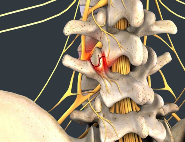 Lumbar Facets Syndrome