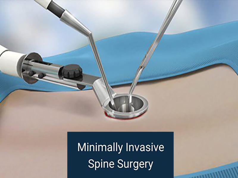 Minimally Invasive Spine Surgery in NJ and NYC